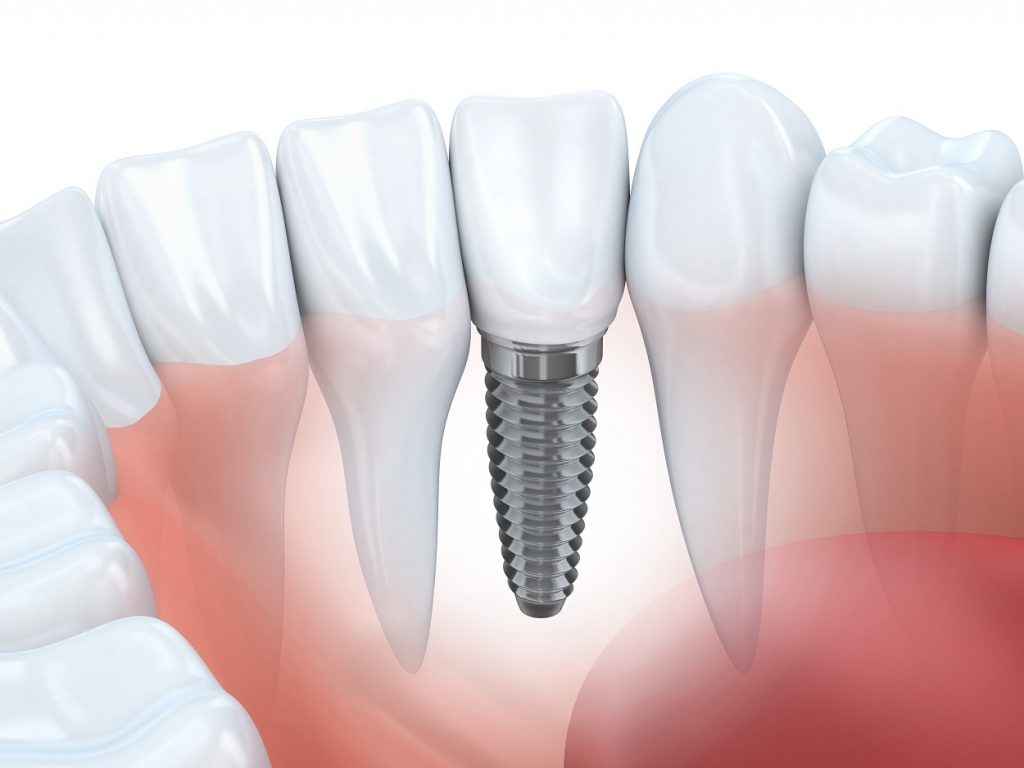 Implant stomatologiczny Dr Szadowski Implantologia i Stomatologia Estetyczna