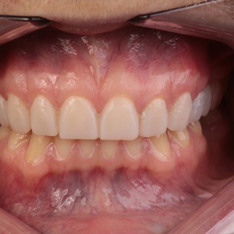 Poprawione zęby Dr Szadowski Implantologia i Stomatologia Estetyczna