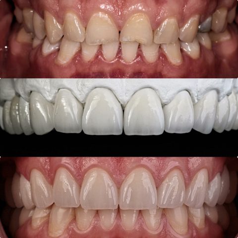 Naprawa zębów Dr Szadowski Implantologia i Stomatologia Estetyczna
