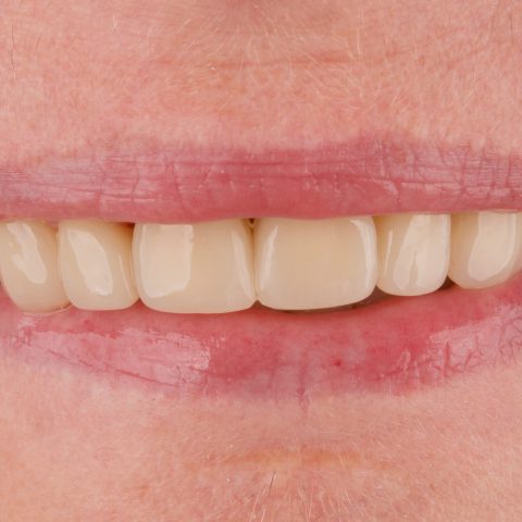 Białe zęby Dr Szadowski Implantologia i Stomatologia Estetyczna