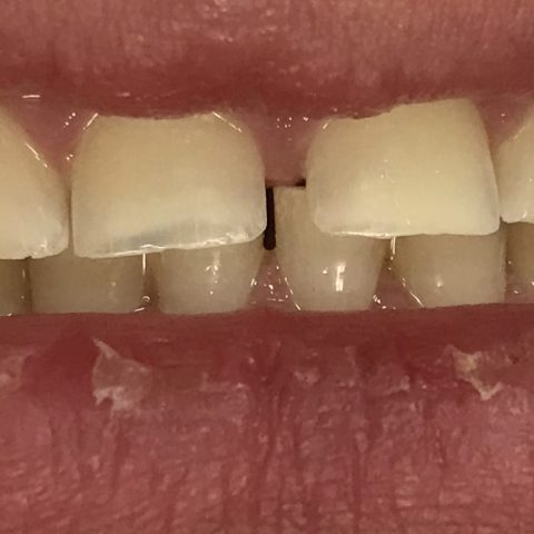 Białe zęby Dr Szadowski Implantologia i Stomatologia Estetyczna